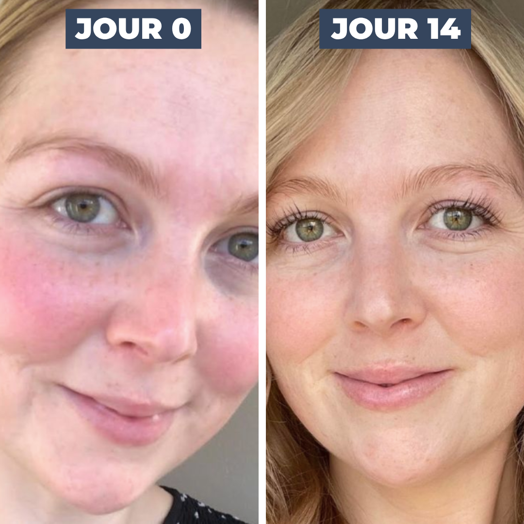 SÉRUM ANTI-ROUGEURS
